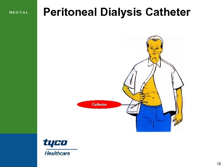 Peritoneal Dialysis Catheter 10 