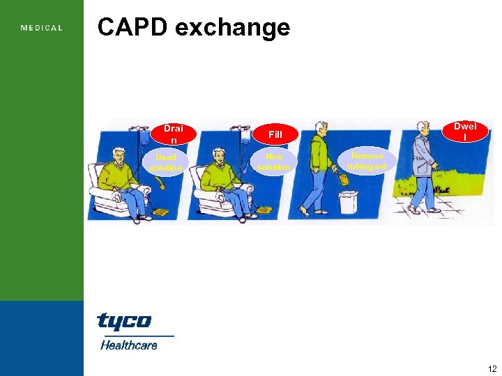 CAPD exchange Drai n Used solution Dwel l Fill New solution Remove tubing set