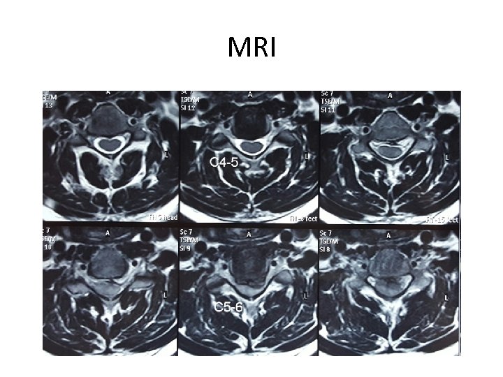 MRI 