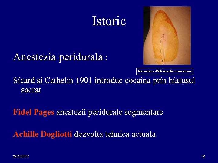 Istoric Anestezia peridurala : Ravedave-Wikimedia commons Sicard si Cathelin 1901 introduc cocaina prin hiatusul