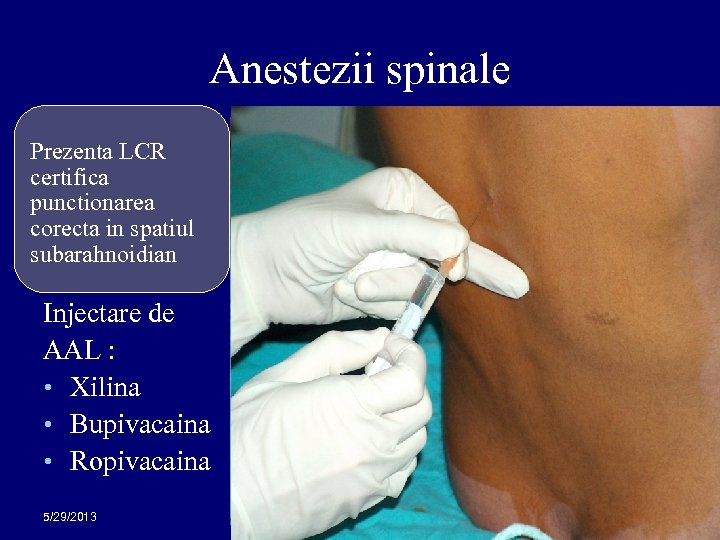 Anestezii spinale Prezenta LCR certifica punctionarea corecta in spatiul subarahnoidian Injectare de AAL :