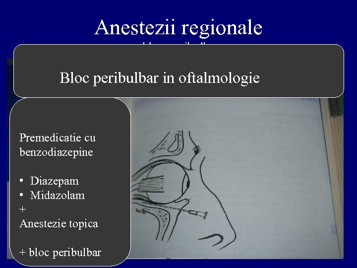 Anestezii regionale - bloc peribulbar - Bloc peribulbar in oftalmologie Premedicatie cu benzodiazepine •