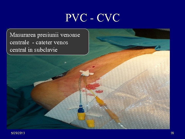 PVC - CVC Masurarea presiunii venoase centrale - cateter venos central in subclavie 5/29/2013