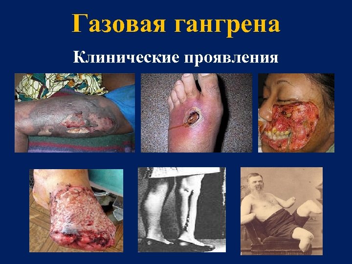 Газовая гангрена Клинические проявления 