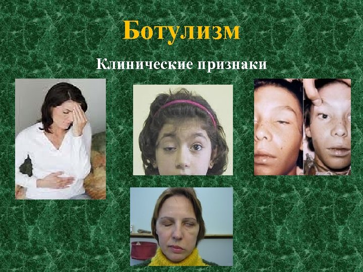 Ботулизм Клинические признаки 