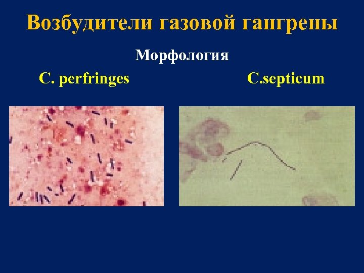 Газовая гангрена картинки