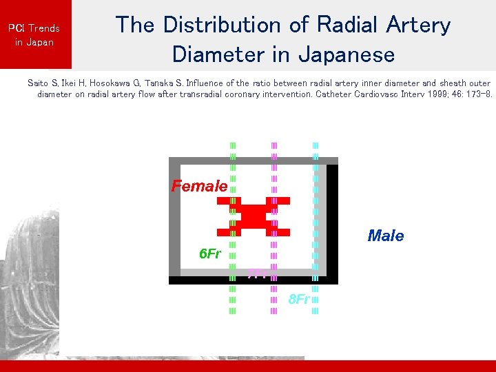 PCI Trends in Japan The Distribution of Radial Artery Diameter in Japanese Saito S,