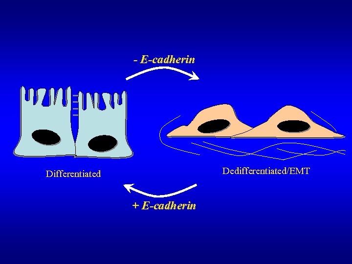 - E-cadherin Dedifferentiated/EMT Differentiated + E-cadherin 