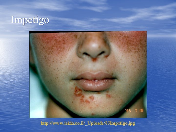 Impetigo http: //www. iskin. co. il/_Uploads/83 Impetigo. jpg 