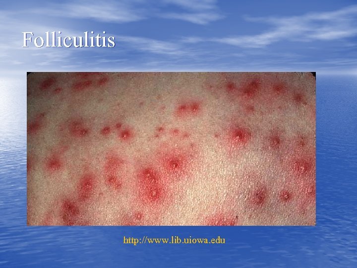 Folliculitis http: //www. lib. uiowa. edu 
