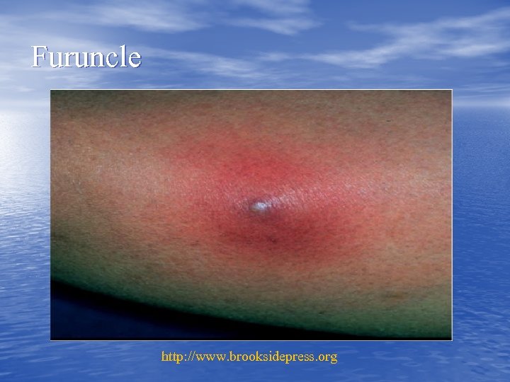 Furuncle http: //www. brooksidepress. org 