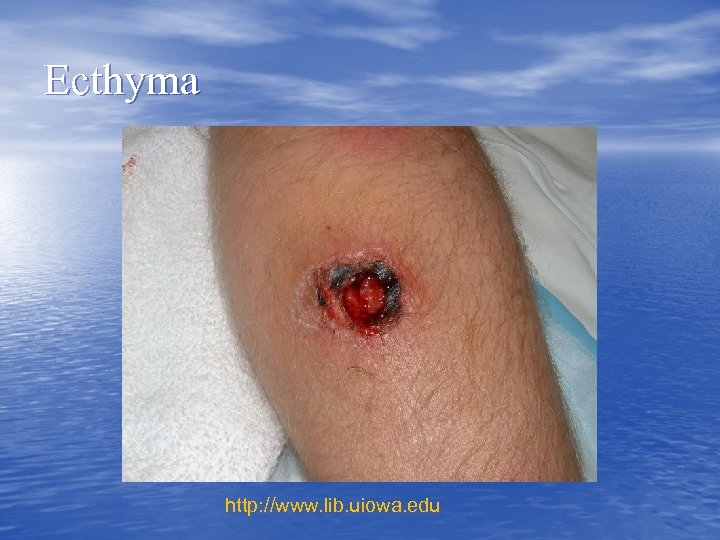 Ecthyma http: //www. lib. uiowa. edu 