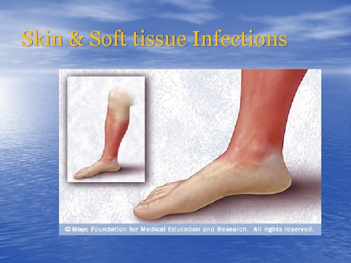 Skin & Soft tissue Infections 