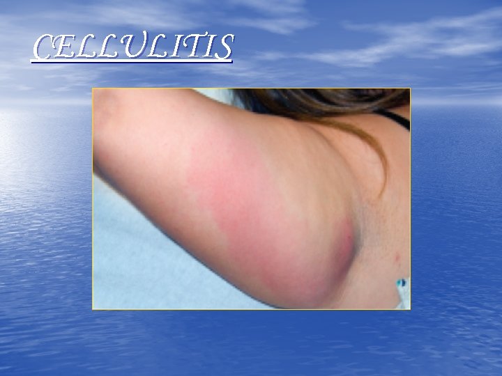 CELLULITIS 