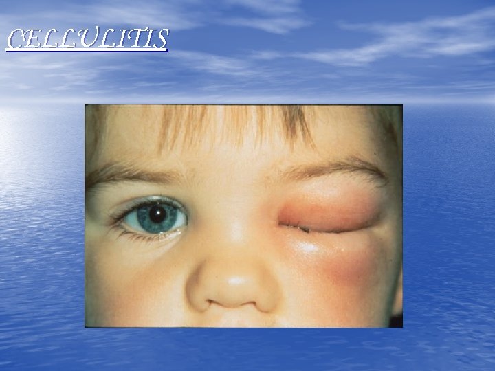 CELLULITIS 