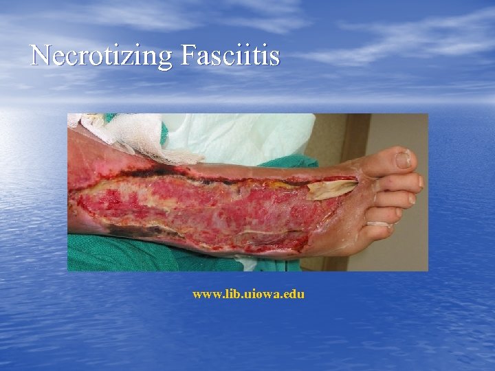 Necrotizing Fasciitis www. lib. uiowa. edu 