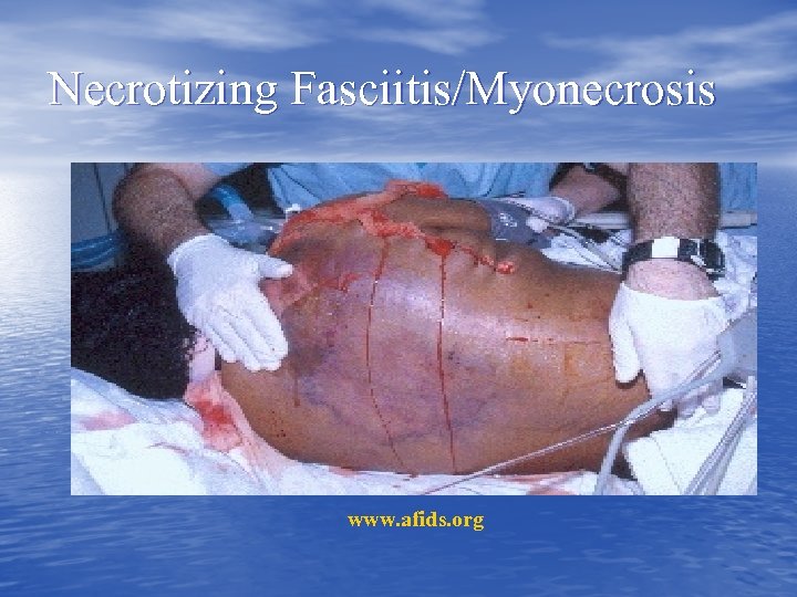 Necrotizing Fasciitis/Myonecrosis www. afids. org 