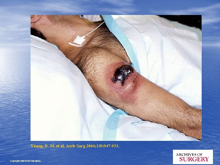 Young, D. M. et al. Arch Surg 2004; 139: 947 -953. Copyright restrictions may