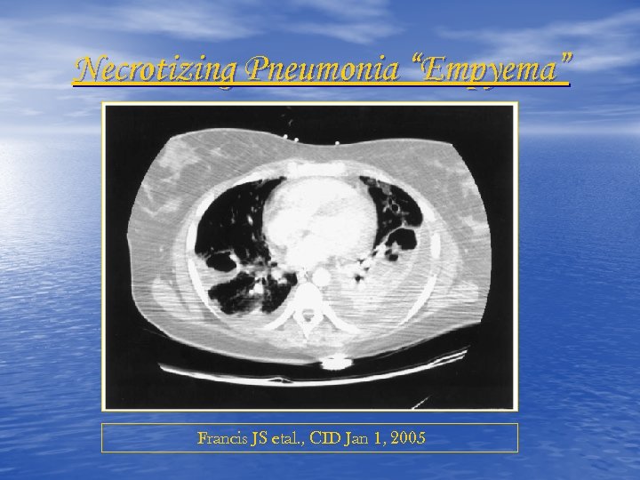 Necrotizing Pneumonia “Empyema” Francis JS etal. , CID Jan 1, 2005 