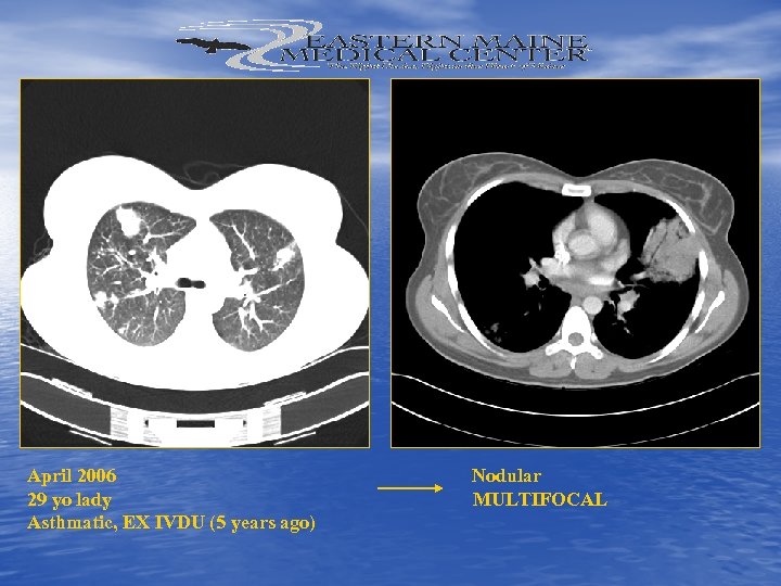 April 2006 Nodular 29 yo lady MULTIFOCAL Asthmatic, EX IVDU (5 years ago) 