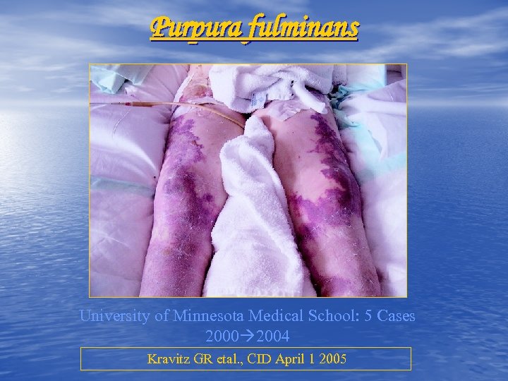 Purpura fulminans University of Minnesota Medical School: 5 Cases 2000 2004 Kravitz GR etal.