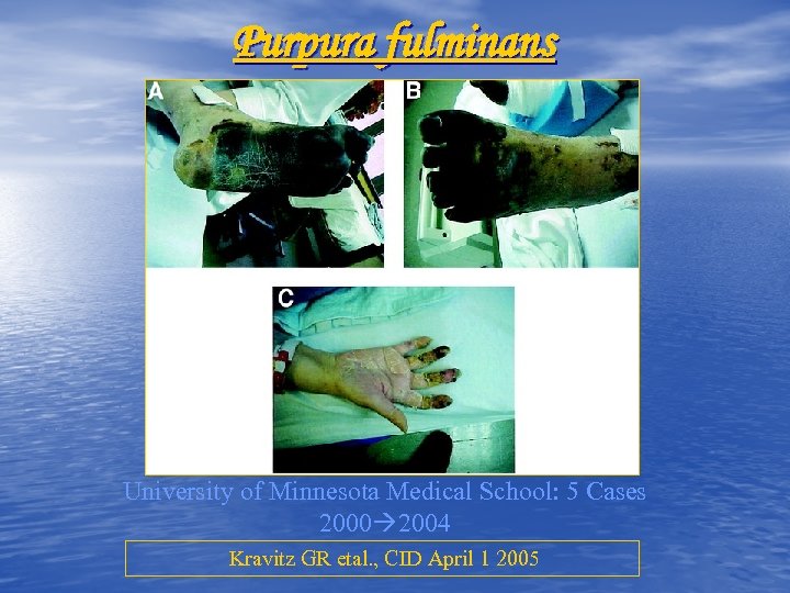 Purpura fulminans University of Minnesota Medical School: 5 Cases 2000 2004 Kravitz GR etal.