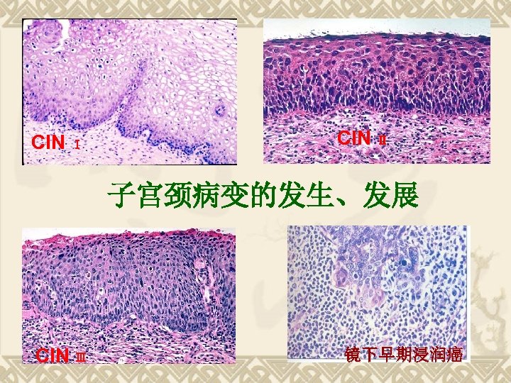 CIN Ⅰ CIN Ⅱ 子宫颈病变的发生、发展 CIN Ⅲ 镜下早期浸润癌 