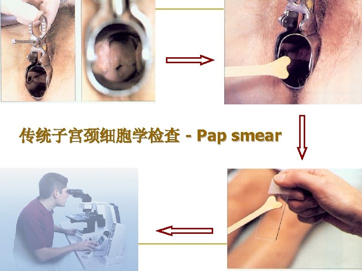 传统子宫颈细胞学检查 - Pap smear 