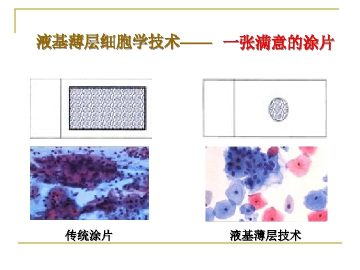 液基薄层细胞学技术—— 一张满意的涂片 传统涂片 液基薄层技术 