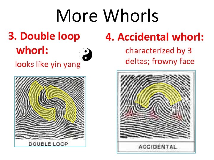 More Whorls 3. Double loop whorl: looks like yin yang 4. Accidental whorl: characterized