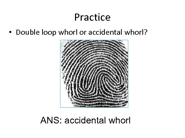 Practice • Double loop whorl or accidental whorl? ANS: accidental whorl 
