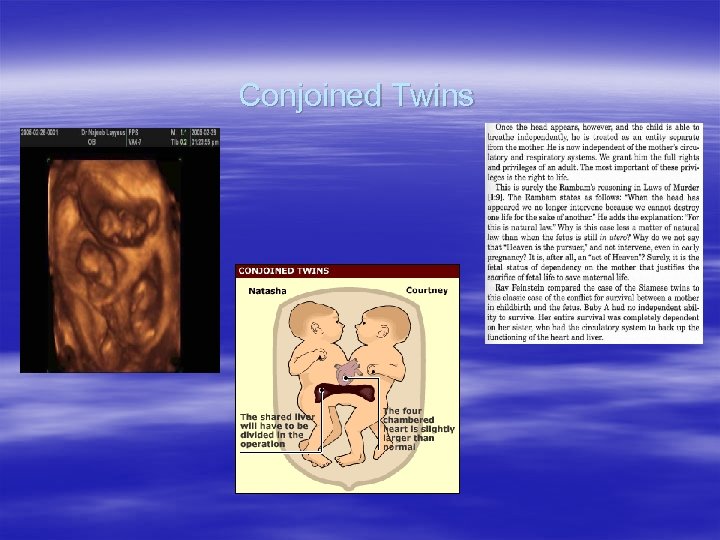 Conjoined Twins 