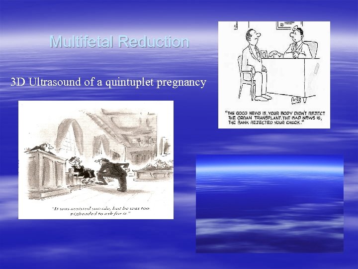 Multifetal Reduction 3 D Ultrasound of a quintuplet pregnancy 
