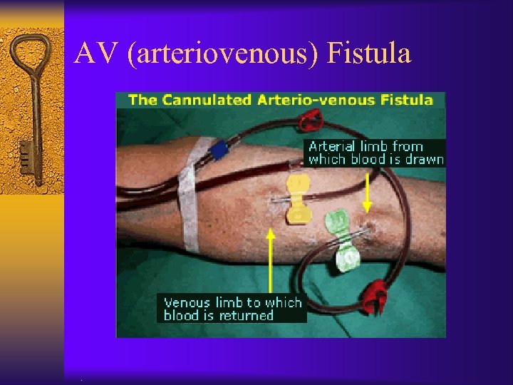 AV (arteriovenous) Fistula . 