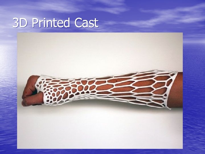 3 D Printed Cast 