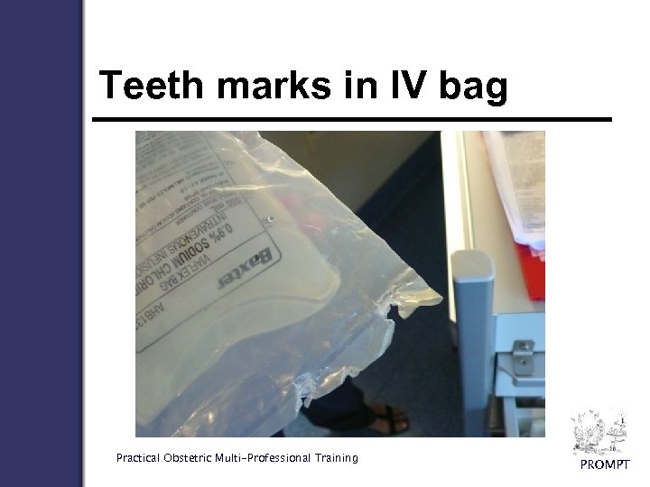 Teeth marks in IV bag Practical Obstetric Multi-Professional Training PROMPT 