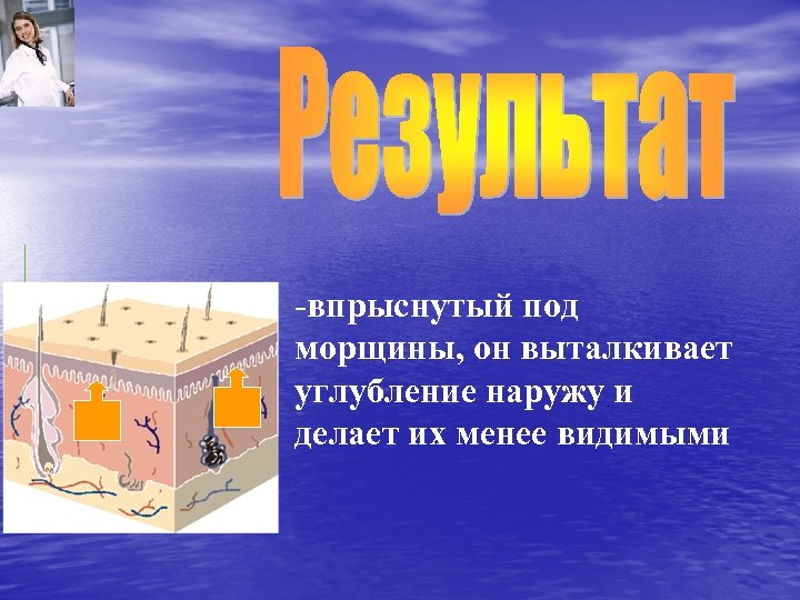 -впрыснутый под морщины, он выталкивает углубление наружу и делает их менее видимыми 