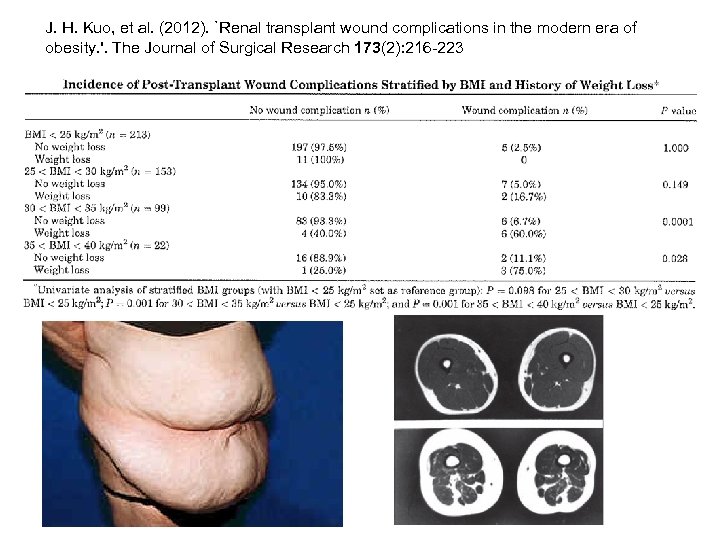 J. H. Kuo, et al. (2012). `Renal transplant wound complications in the modern era