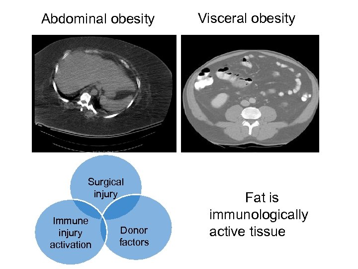 Abdominal obesity Surgical injury Immune injury activation Donor factors Visceral obesity Fat is immunologically