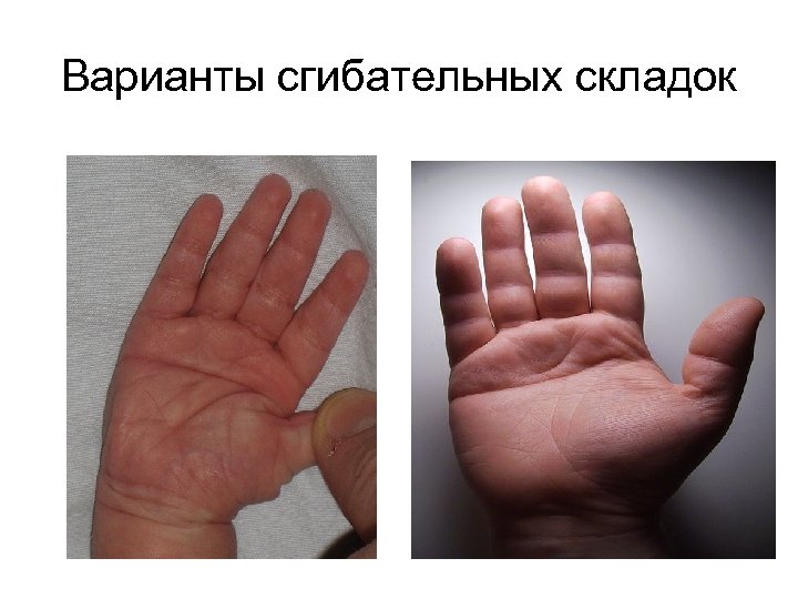 Варианты сгибательных складок 