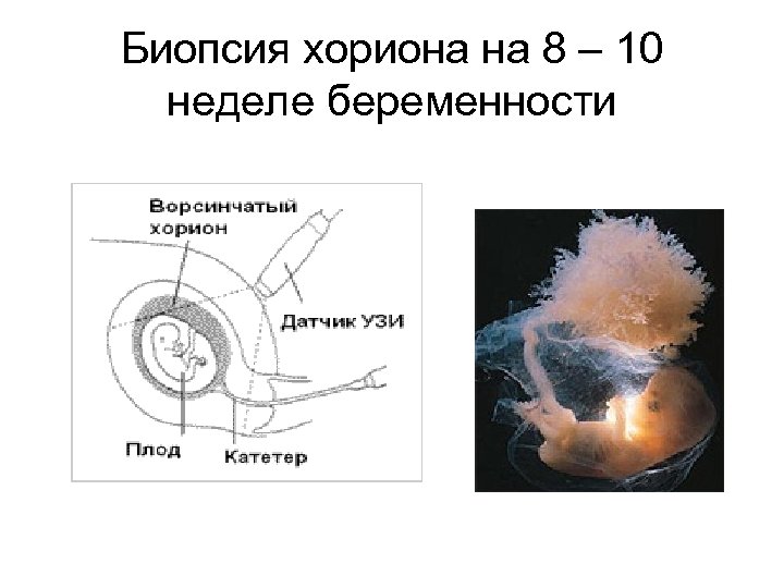 Биопсия хориона на 8 – 10 неделе беременности 