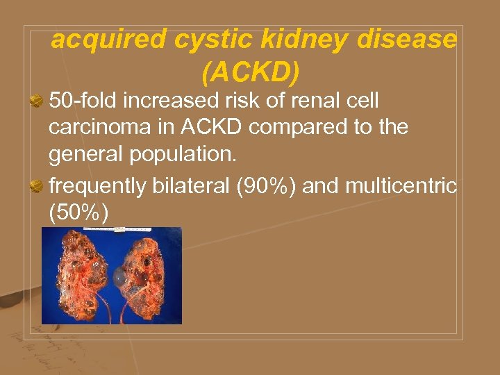  acquired cystic kidney disease (ACKD) 50 -fold increased risk of renal cell carcinoma