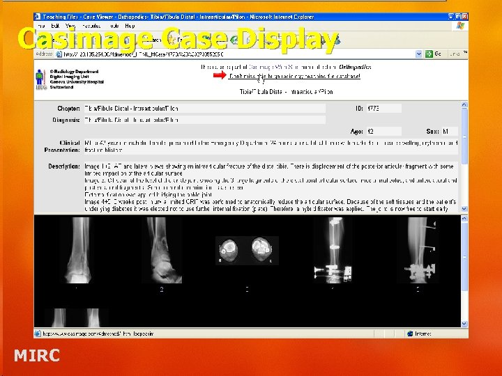 Casimage Case Display MIRC 