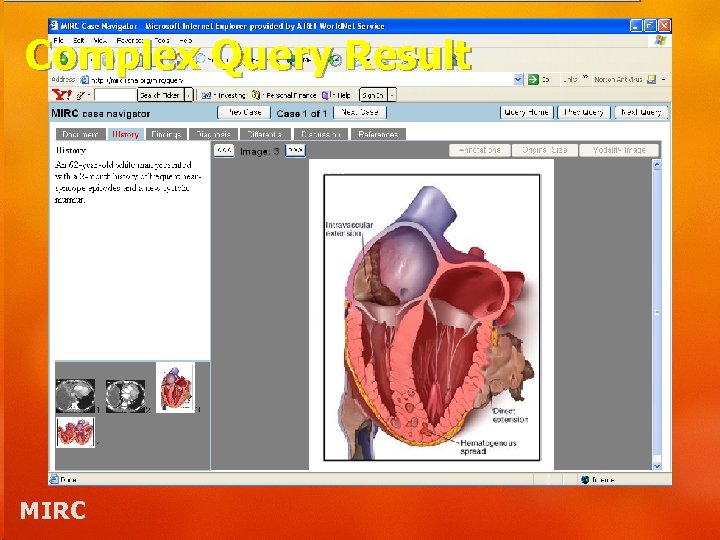 Complex Query Result MIRC 