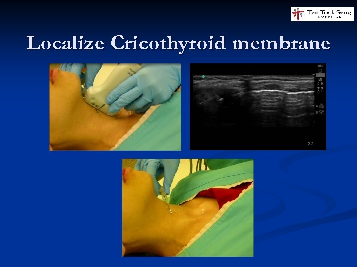 Localize Cricothyroid membrane 