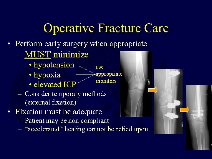 Operative Fracture Care • Perform early surgery when appropriate – MUST minimize • hypotension