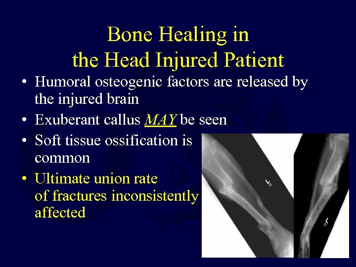 Bone Healing in the Head Injured Patient • Humoral osteogenic factors are released by