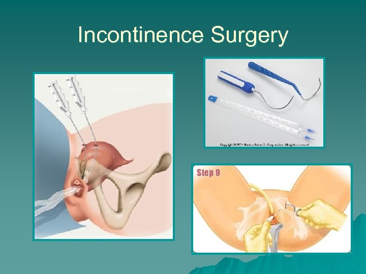 Incontinence Surgery 