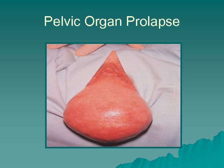 Pelvic Organ Prolapse 