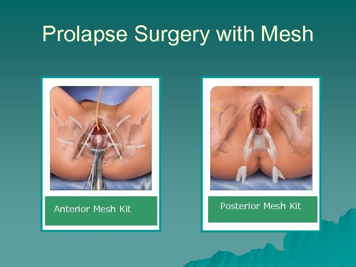 Prolapse Surgery with Mesh Anterior Mesh Kit Posterior Mesh Kit 